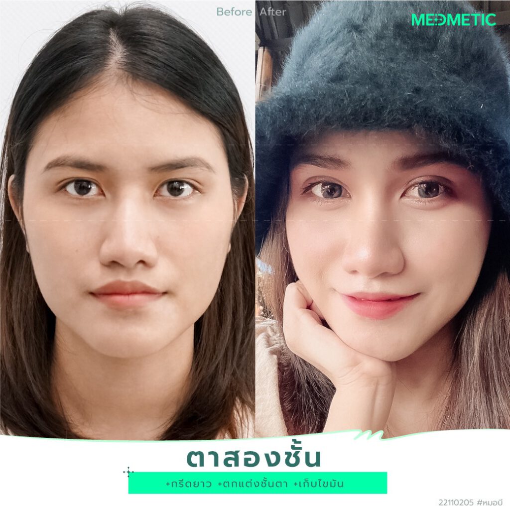 ทำตา 2 ชั้น รีวิว