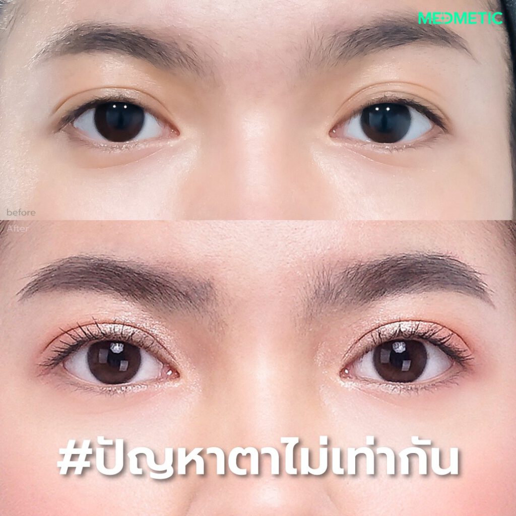 ทําตา2ชั้นที่ไหนดีราคาไม่แพง
