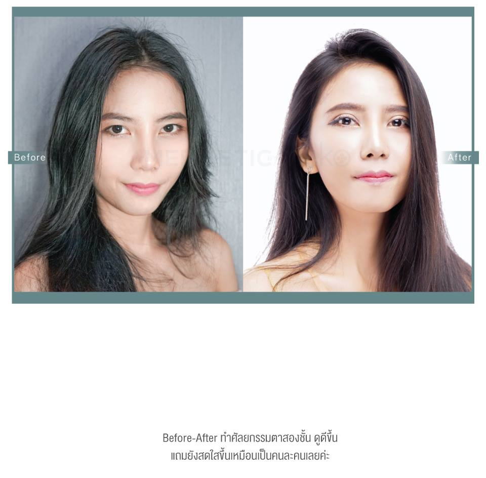 ทำตา 2 ชั้น Medmetic
