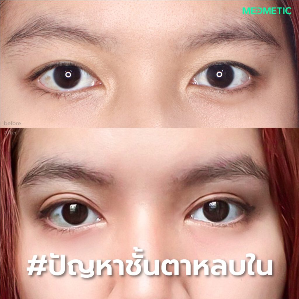 ทำตาสองชั้นที่ไหน