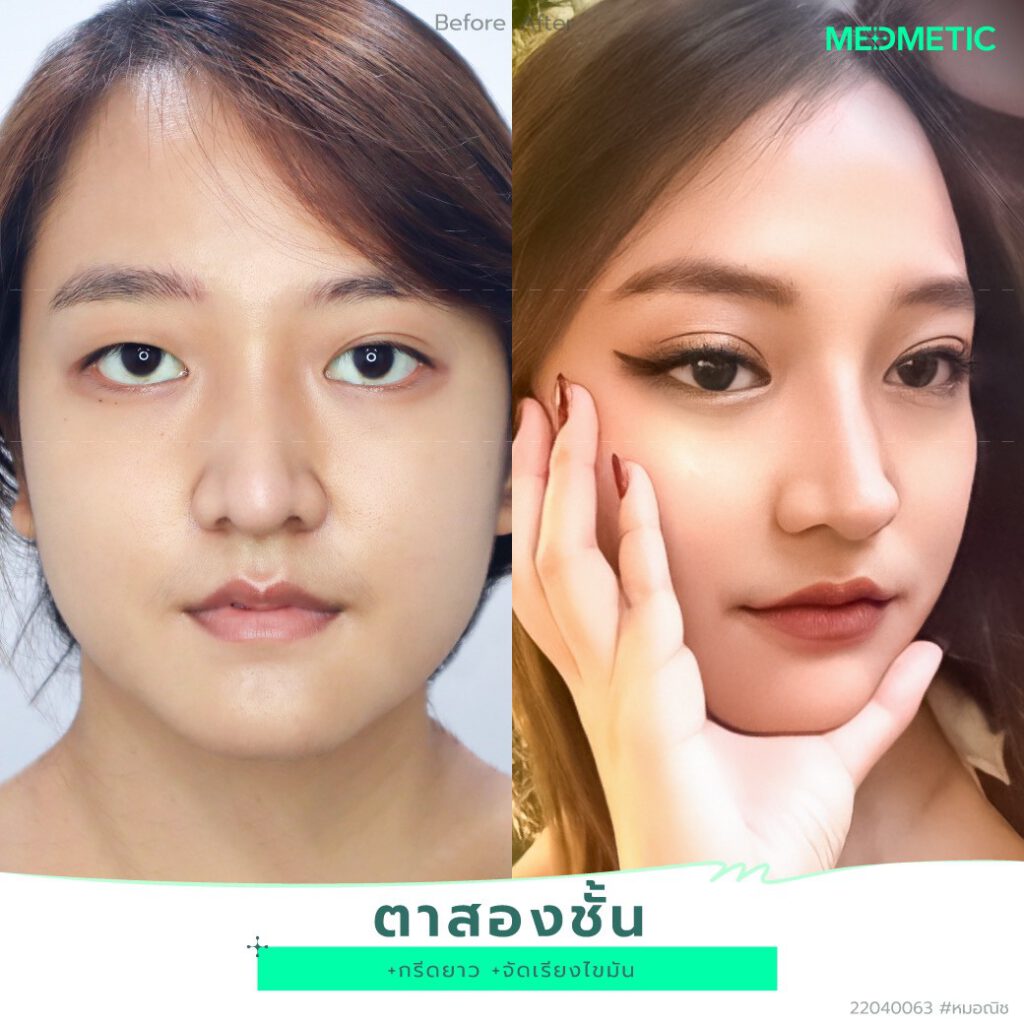 ทำตา2ชั้นที่ไหนดี