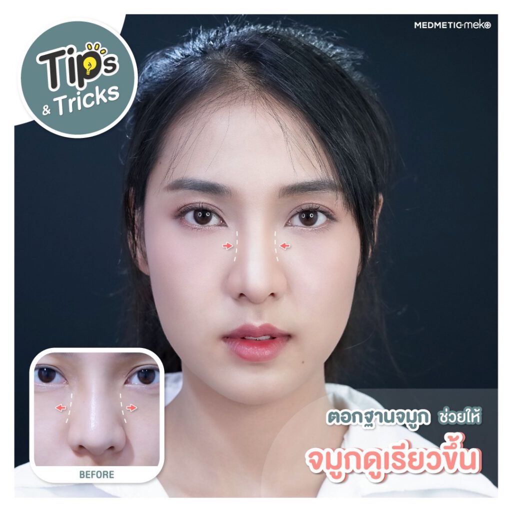 เสริมจมูกแบบตอกปรับฐาน