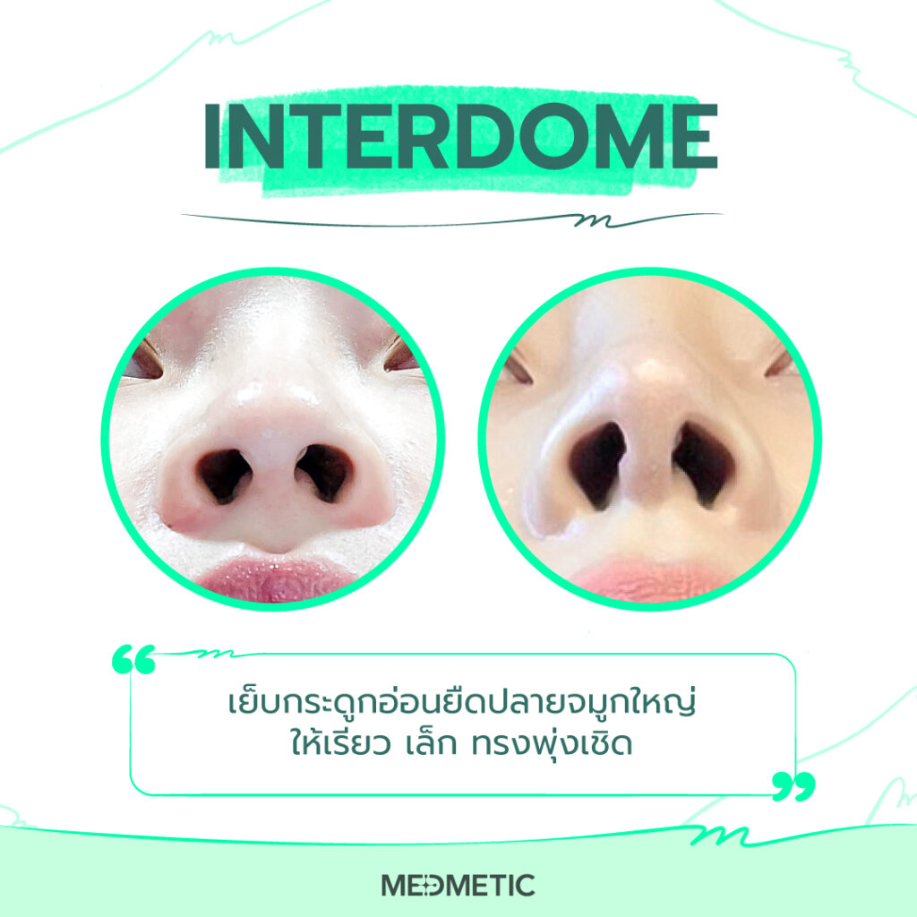 เสริมจมูกเย็บอินเตอร์โดม