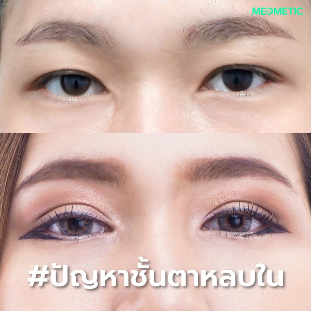 ปัญหาชั้นตาหลบใน