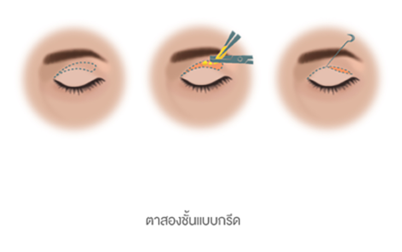 เทคนิคกรีดยาว