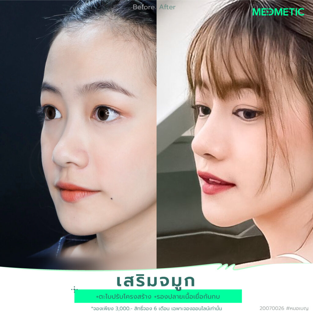 จมูกทรงสโลปปลายบาร์บี้