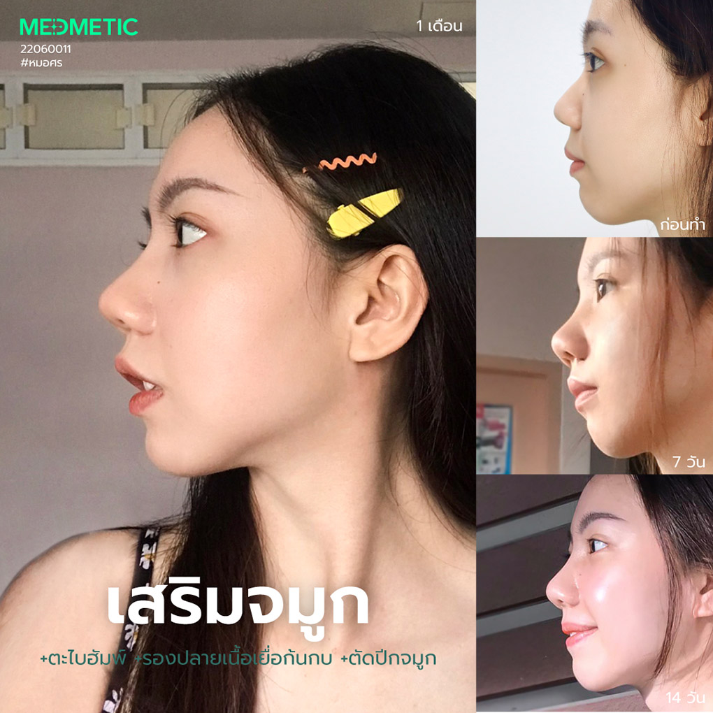 จมูกทรงสโลปปลายพุ่งเชิด