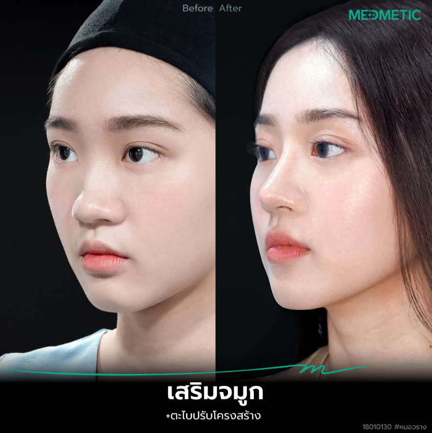 ทรงจมูกหยดน้ำ