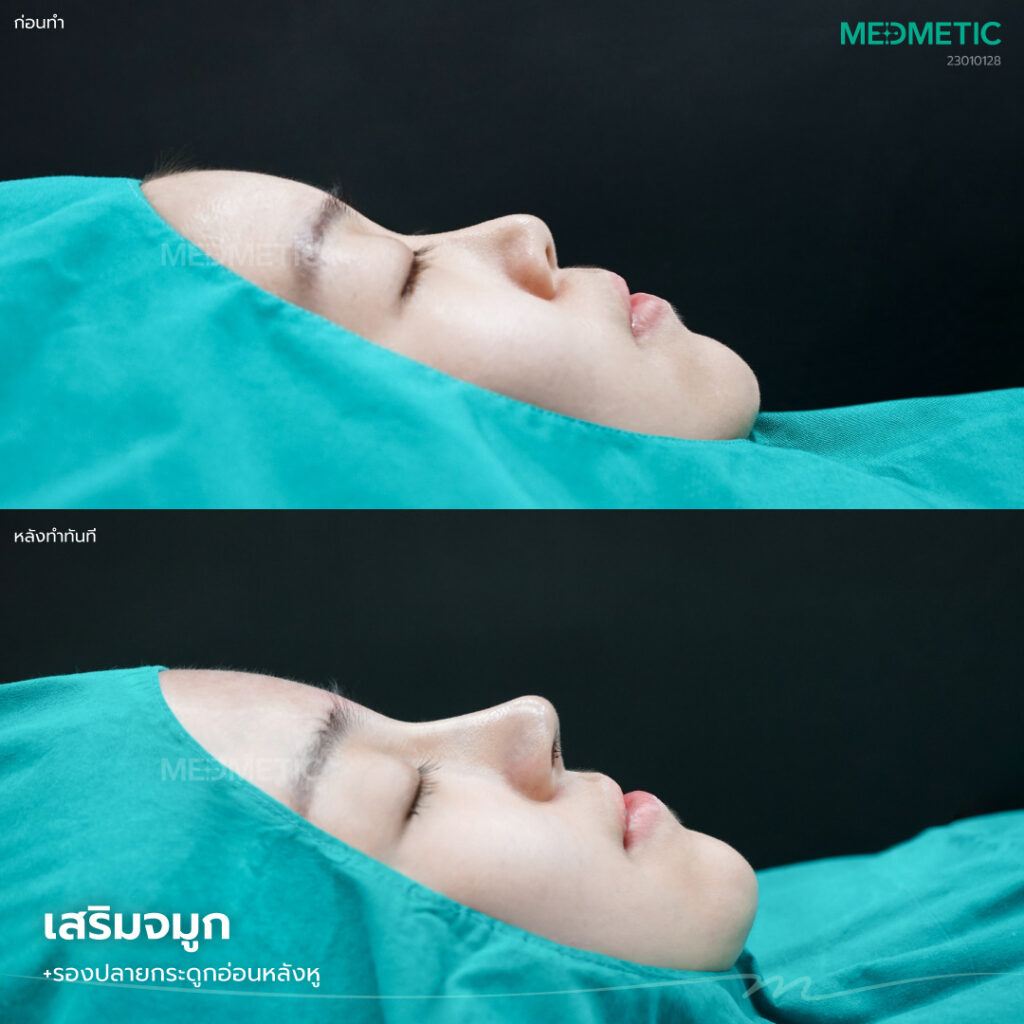 จมูกทรงหยดน้ำแบบเซมิ-โอเพ่น