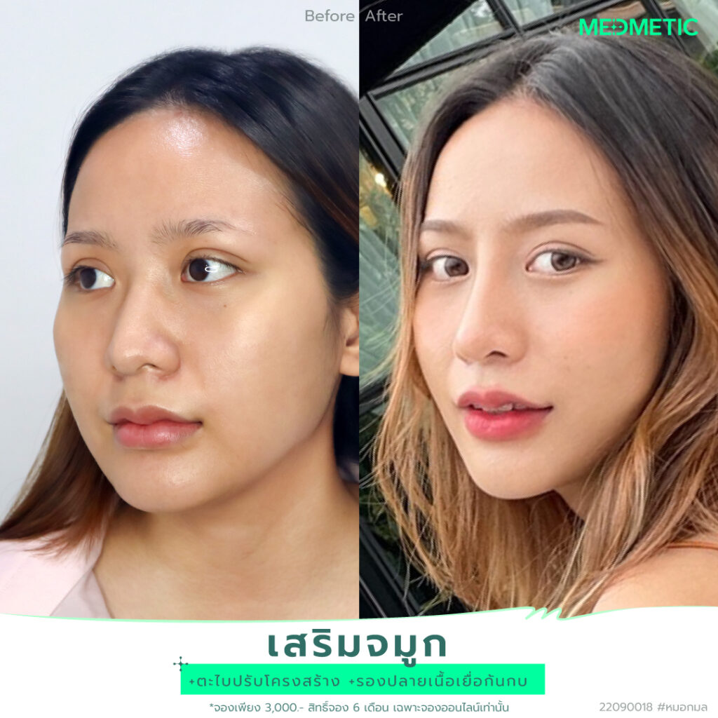 ทำจมูกสายฝอ