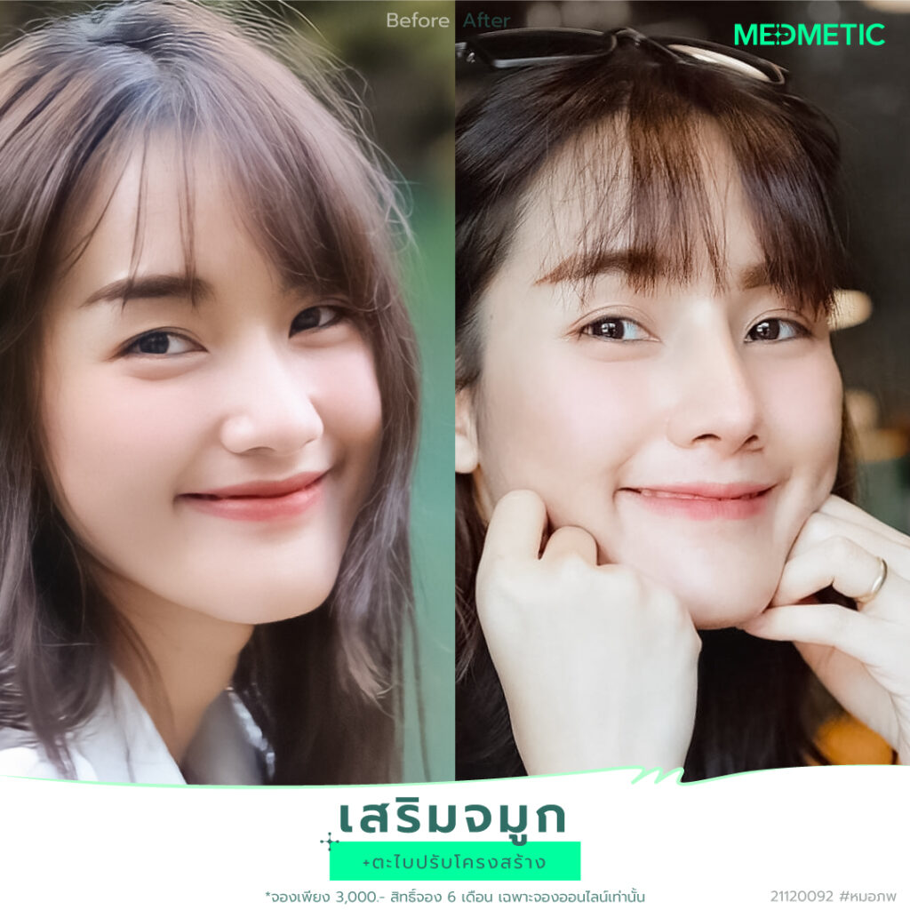 รีวิวทรงจมูกสายฝอ