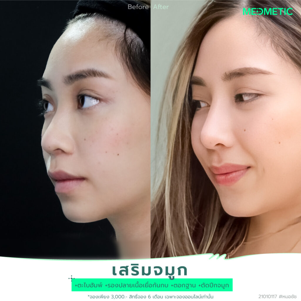 ตัดปีกจมูก ราคา