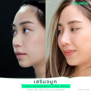 ตัดปีกจมูก ราคา